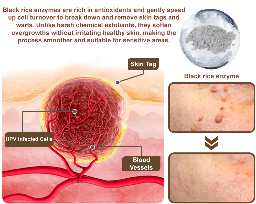 𝐙𝐯𝐨𝐞𝐯𝐨® Rice Bran Extract Cream 👩⚕️ FDA-Certified (For removing warts and skin growths, eliminating skin hyperplasia and keratin buildup, treating skin cancer, age spots, and hyperpigmentation)