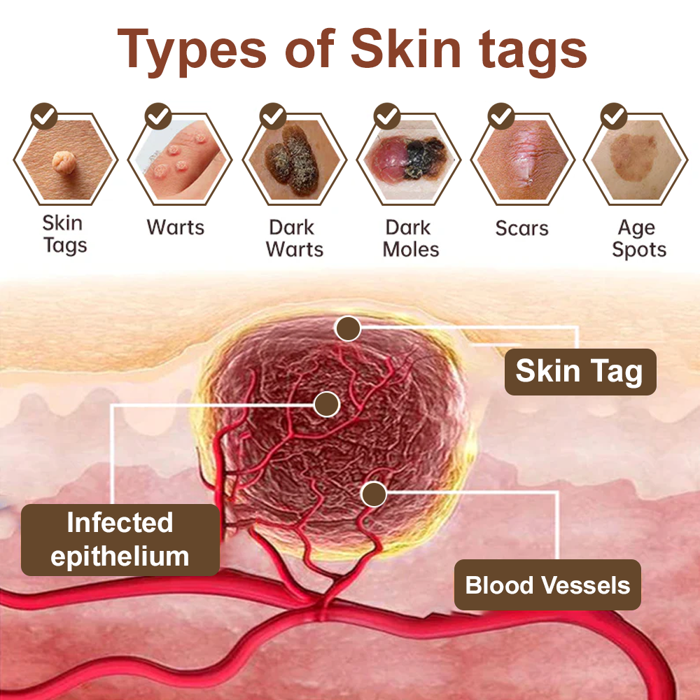 𝐙𝐯𝐨𝐞𝐯𝐨® Rice Bran Extract Cream 👩⚕️ FDA-Certified (For removing warts and skin growths, eliminating skin hyperplasia and keratin buildup, treating skin cancer, age spots, and hyperpigmentation)