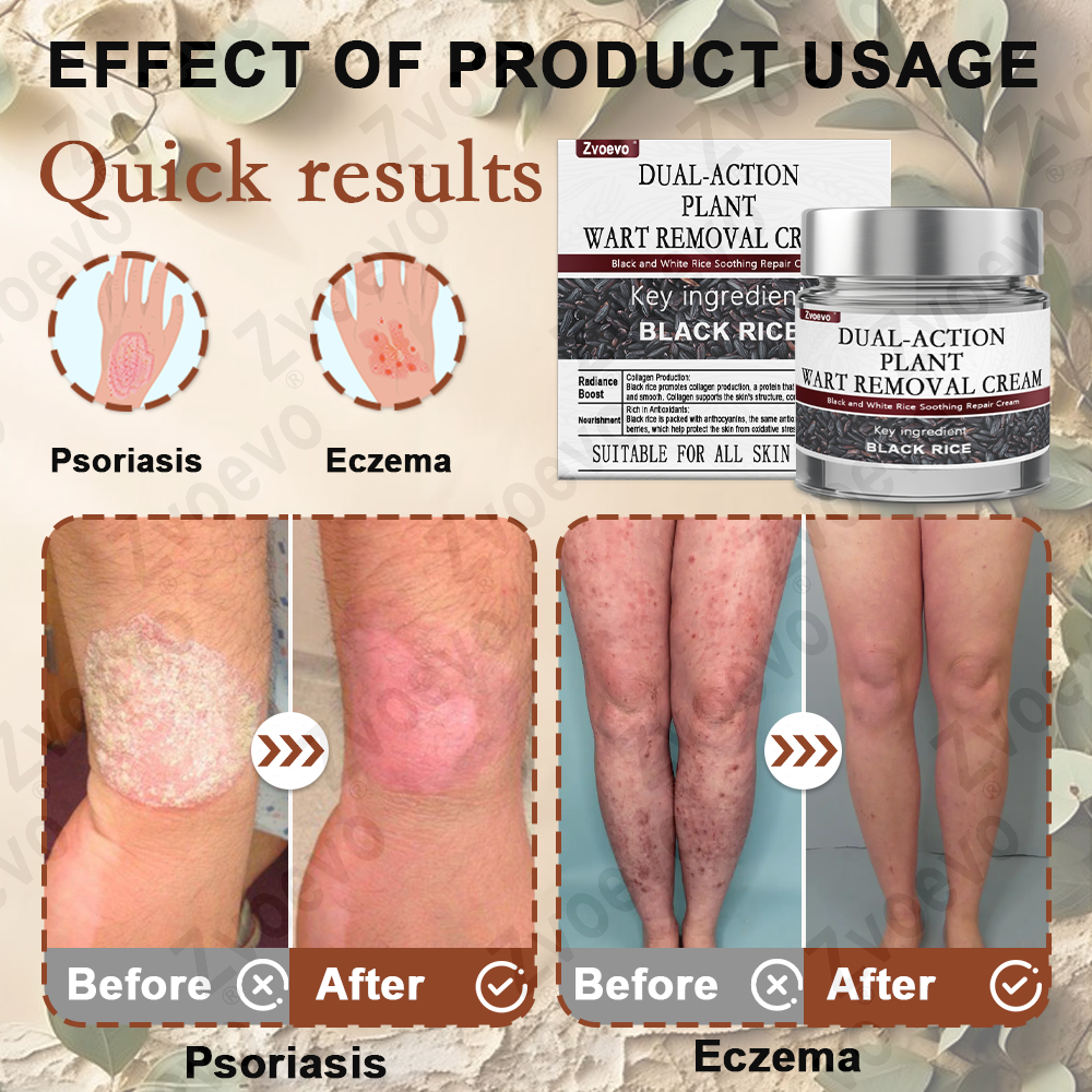 𝐙𝐯𝐨𝐞𝐯𝐨® Rice Bran Extract Cream 👩⚕️ FDA-Certified (For removing warts and skin growths, eliminating skin hyperplasia and keratin buildup, treating skin cancer, age spots, and hyperpigmentation)