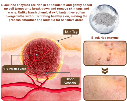 ✅ FDA Approved：Zvoevo® Rice Bran Extract Cream 👩‍⚕️ FDA-Certified (For removing warts and skin growths, eliminating skin hyperplasia and keratin buildup, treating skin cancer, age spots, and hyperpigmentation)