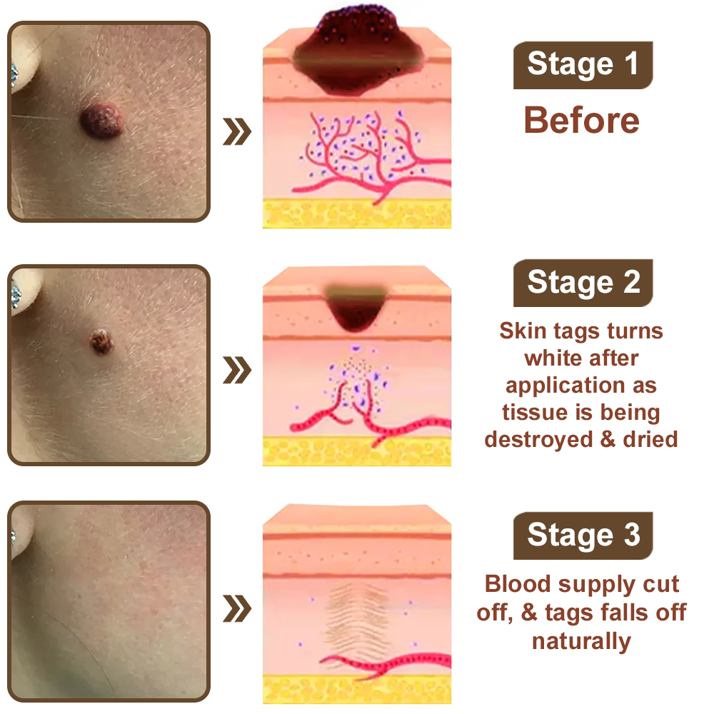 ✅ FDA Approved：Zvoevo® Rice Bran Extract Cream 👩‍⚕️ FDA-Certified (For removing warts and skin growths, eliminating skin hyperplasia and keratin buildup, treating skin cancer, age spots, and hyperpigmentation)