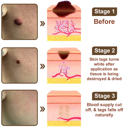 ✅ FDA Approved：Zvoevo® Rice Bran Extract Cream 👩‍⚕️ FDA-Certified (For removing warts and skin growths, eliminating skin hyperplasia and keratin buildup, treating skin cancer, age spots, and hyperpigmentation)