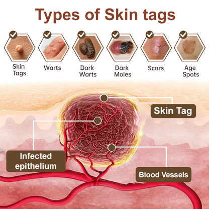 ✅ FDA Approved：Zvoevo® Rice Bran Extract Cream 👩‍⚕️ FDA-Certified (For removing warts and skin growths, eliminating skin hyperplasia and keratin buildup, treating skin cancer, age spots, and hyperpigmentation)