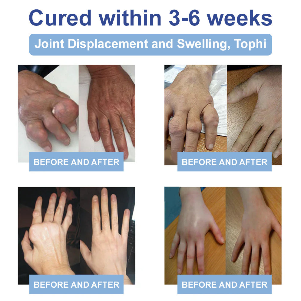 ✅FDA Certified :  Rekulo® Black Rice Pain Healing Bone Cream ( Treatment for arthritis, neuropathyy, rheumatic diseases, sports injuries, twitches and muscle spasms)